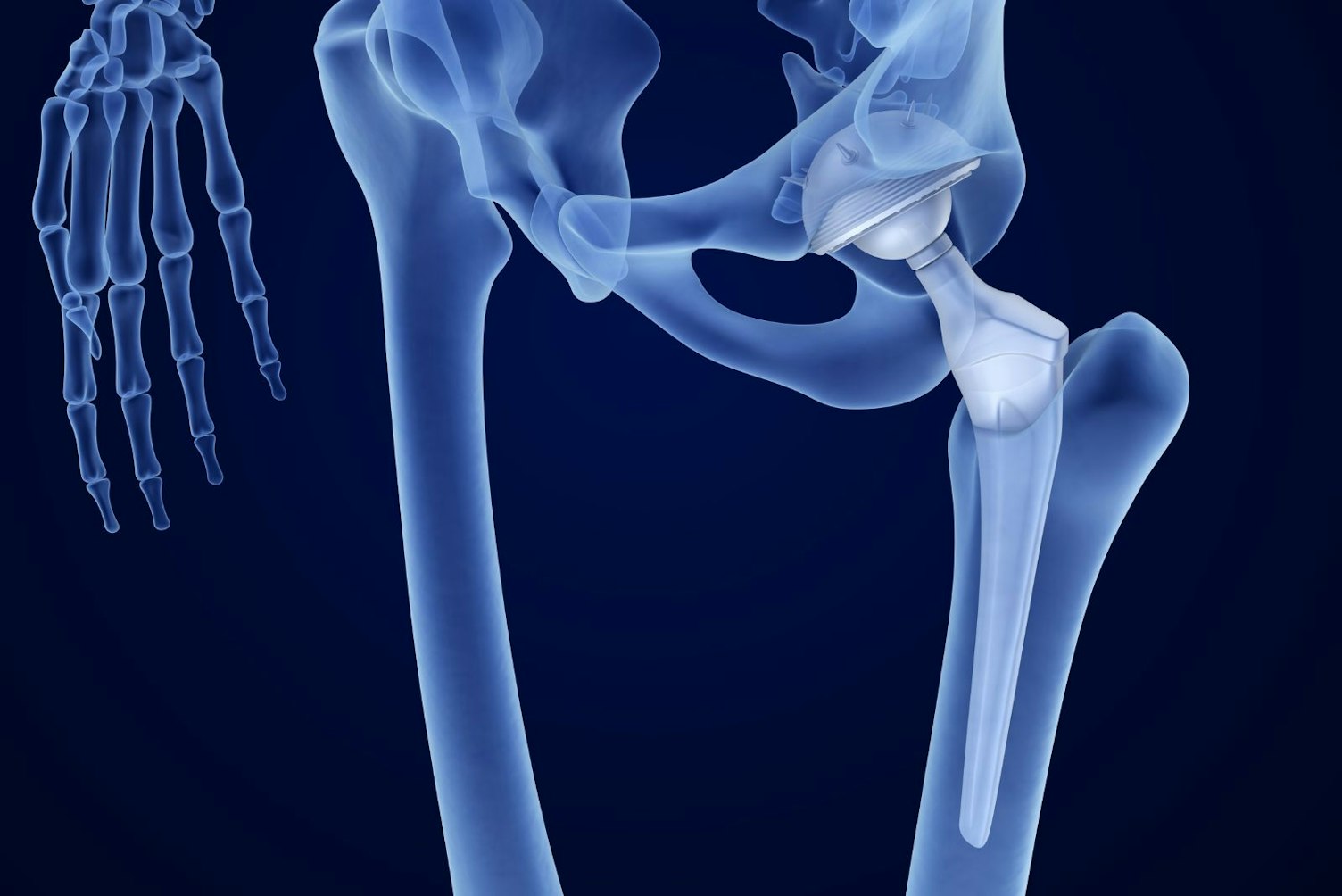 Hip Replacement Implant