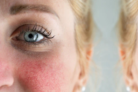 Safety Evaluation of Cosmetic and Cosmeceutical Products for Rosacea prone Skin