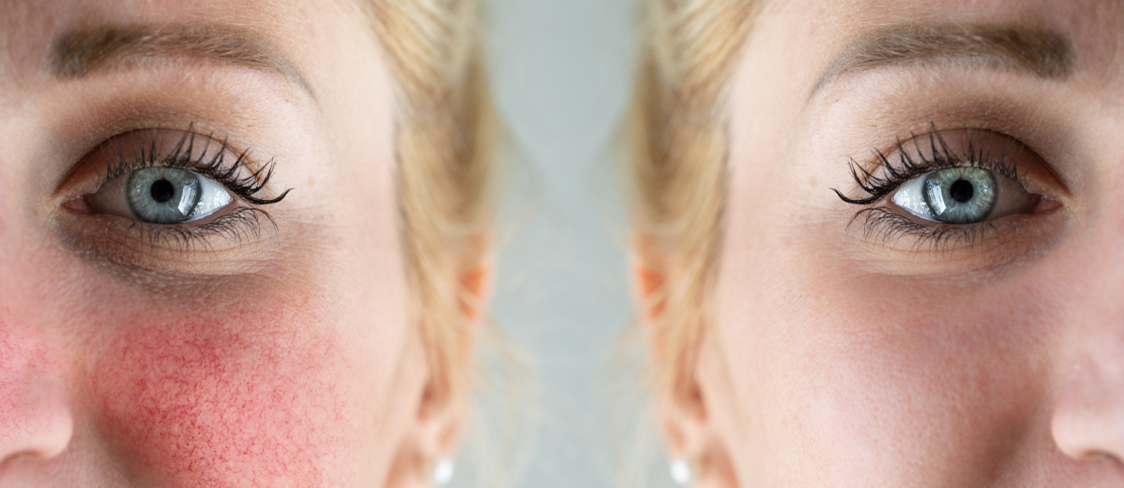 Safety Evaluation of Cosmetic and Cosmeceutical Products for Rosacea prone Skin