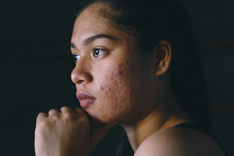 Acne Rosacea