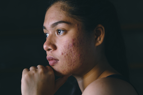 Acne Rosacea