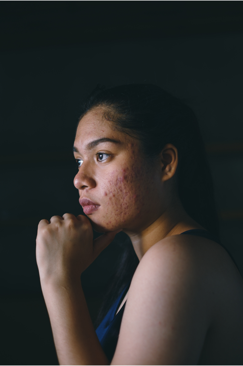 Acne Rosacea