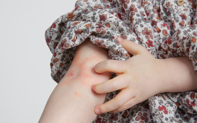 Eczema on kids arm