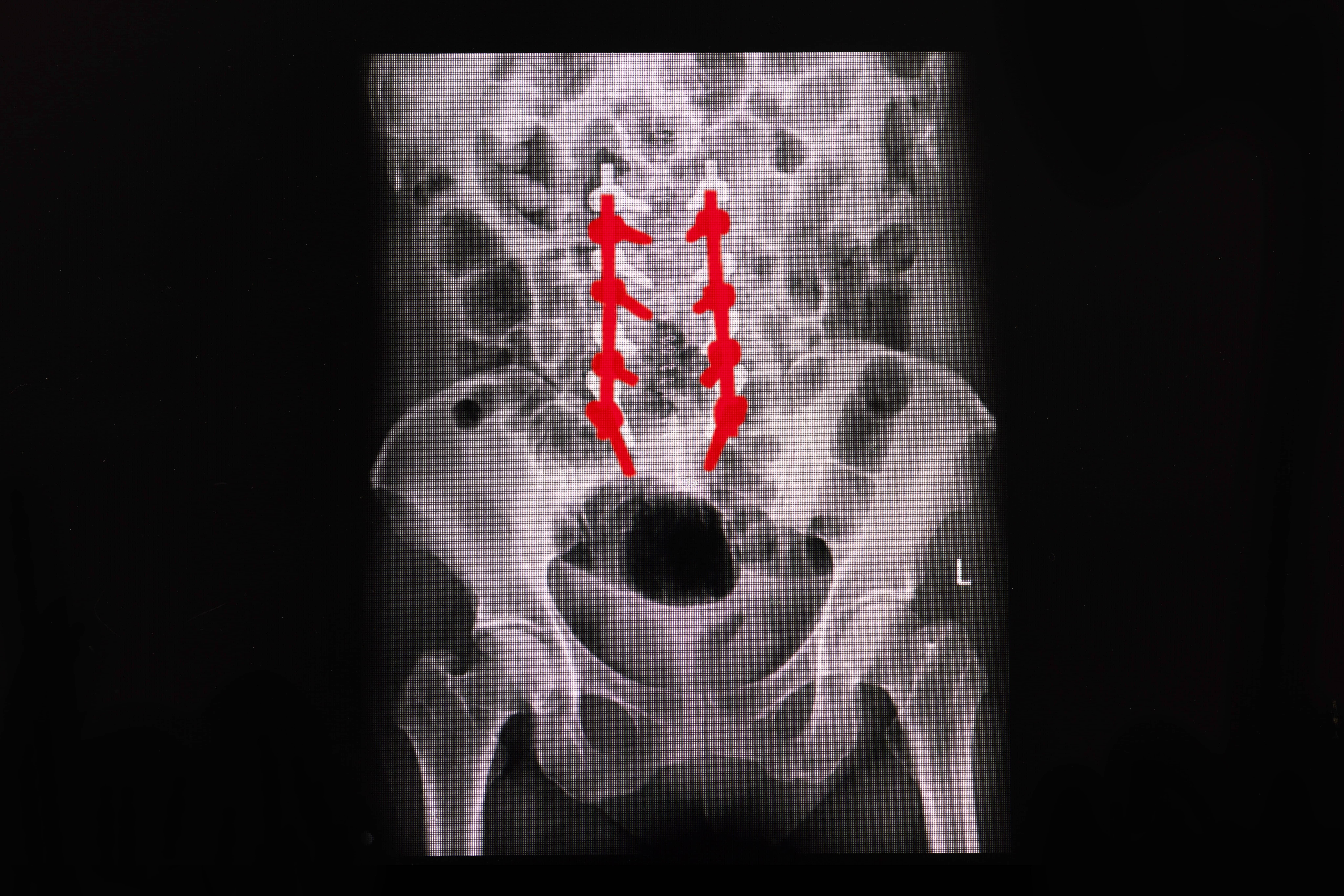 X-ray Film of Spinal Metal Implants