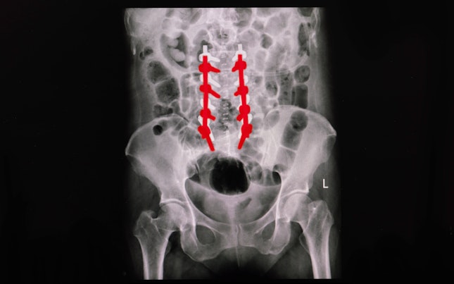 Röntgenfilm van metalen implantaten in de wervelkolom