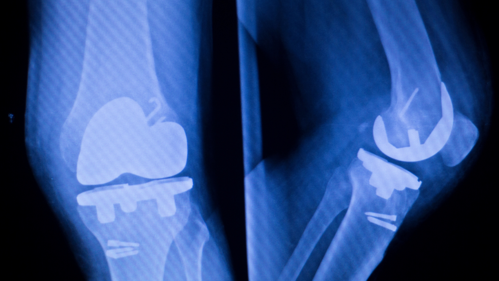 Implant Installed in the Knee